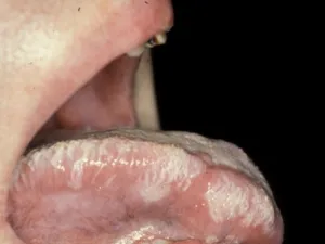 Leucoplasie orale chevelue.