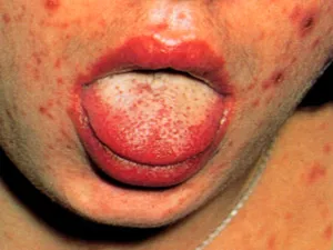 Manifestations cutanéo-muqueuses de la primo-infection à VIH