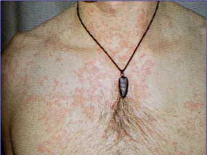 Manifestations cutanéo-muqueuses de la primo-infection à VIH
