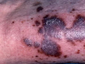 Lésions de sarcome de Kaposi chez une personne atteinte par le VIH.