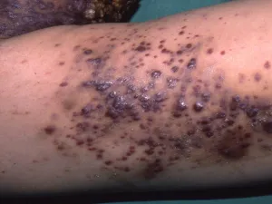 Lésions de sarcome de Kaposi chez une personne atteinte par le VIH.