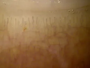 Capillaroscopie normale