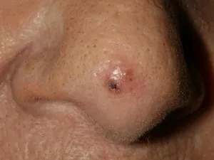 carcinome-basocellulaire_poite-du-nez
