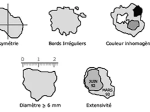 mélanome_règle-ABCDE