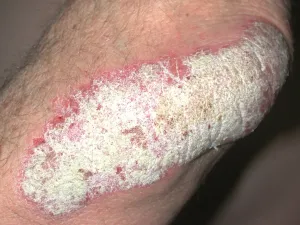 psoriasis-coude_
