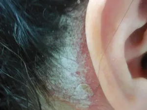 psoriasis-cuir-chevelu_