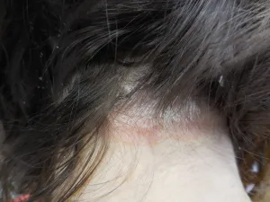 psoriasis-cuir-chevelu