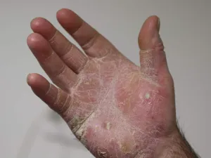 psoriasis-palmaire