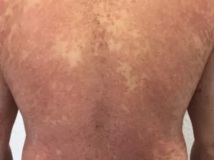 psoriasis_dos