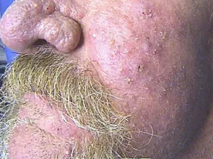 rosacée_rhinophyma IMAGE