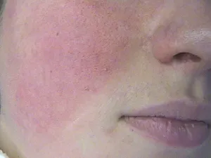 rosacée_vasculaire