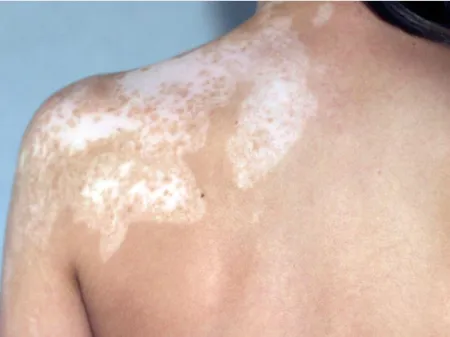 Vitiligo avec lésions en confettis