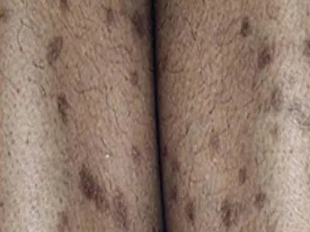 Signes d’inflammation