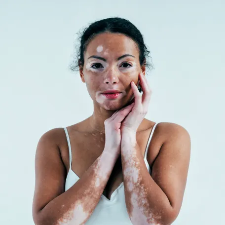 VITILIGO 