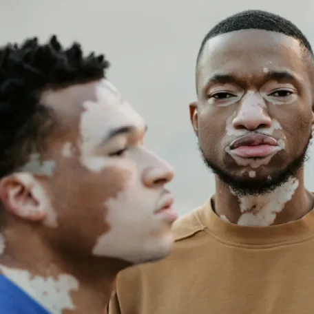 vitiligo