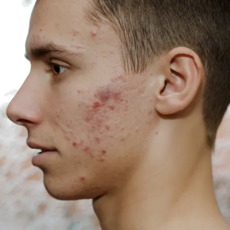 Acné