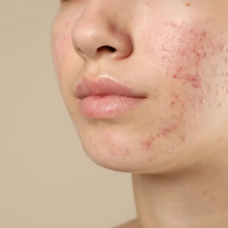 acne iso