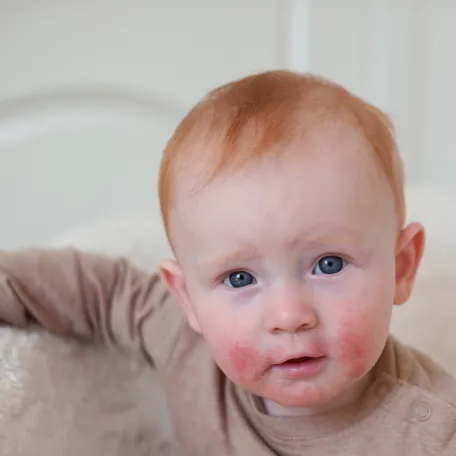 Dermatite atopique enfant