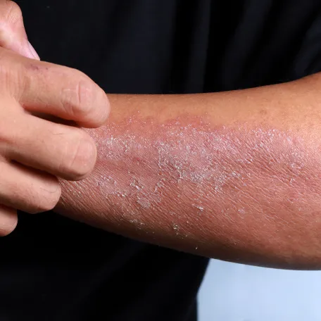 Eczéma de contact BRAS