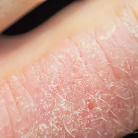 Eczéma de contact CAUSE