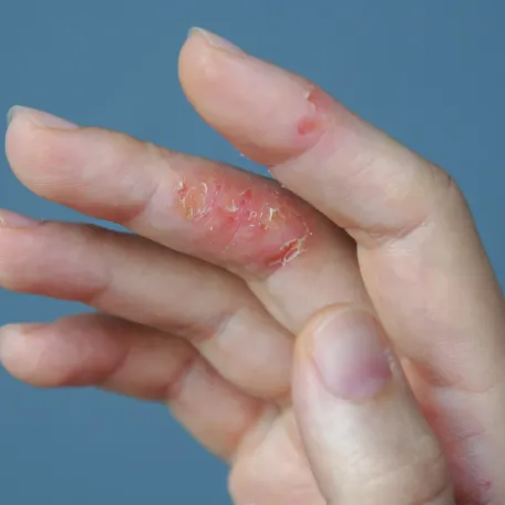 Eczéma de contact DOIGT