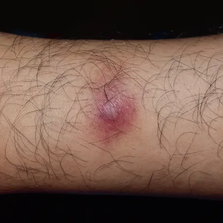 Infections bactériennes