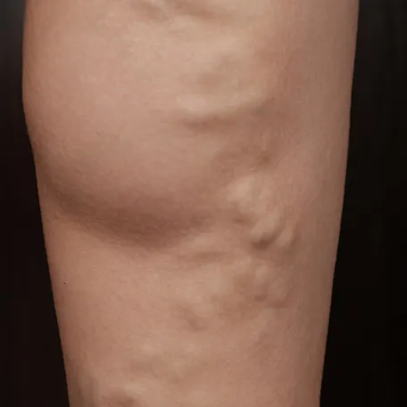 Insuffisance veineuse