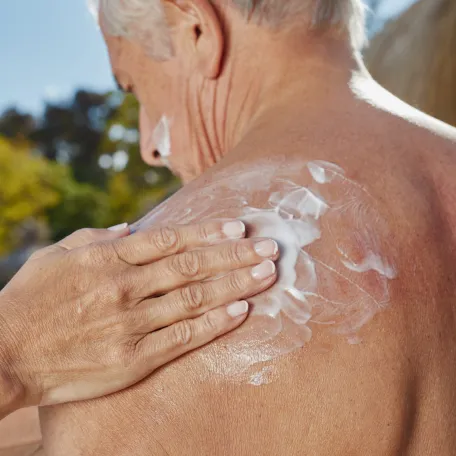 Kératoses actiniques