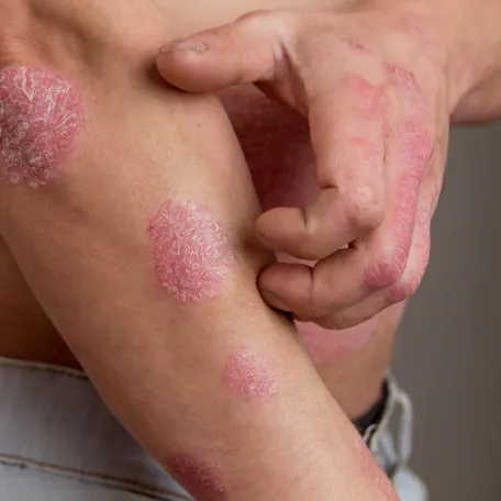 Psoriasis