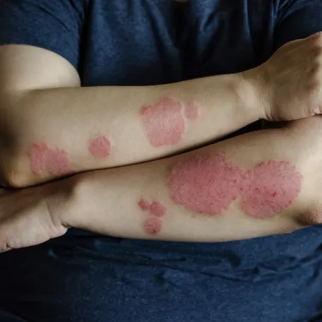 Psoriasis