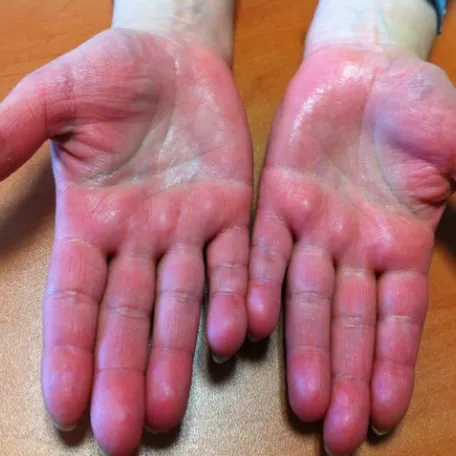 Acrocyanose avec hypersudation