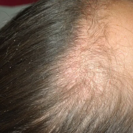 alopécie-traction