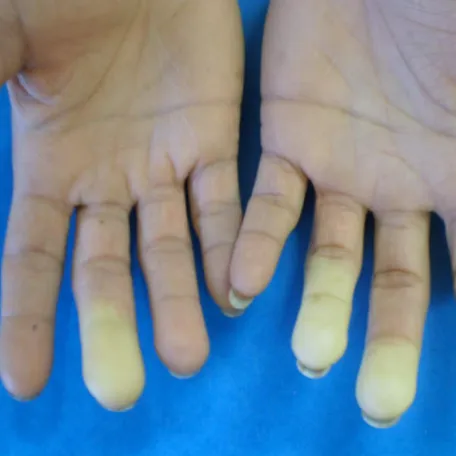 Phase syncopale du Raynaud