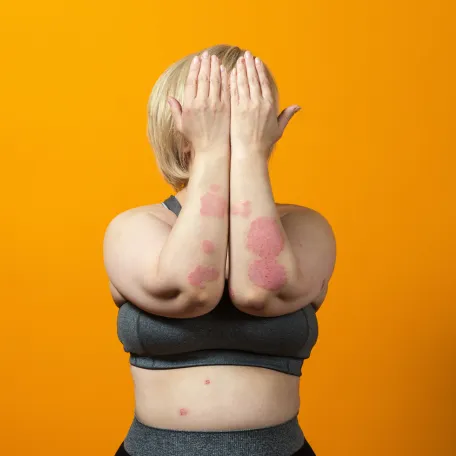 psoriasis