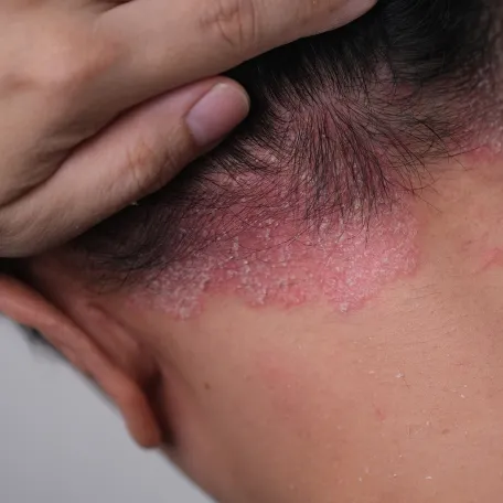 psoriasis