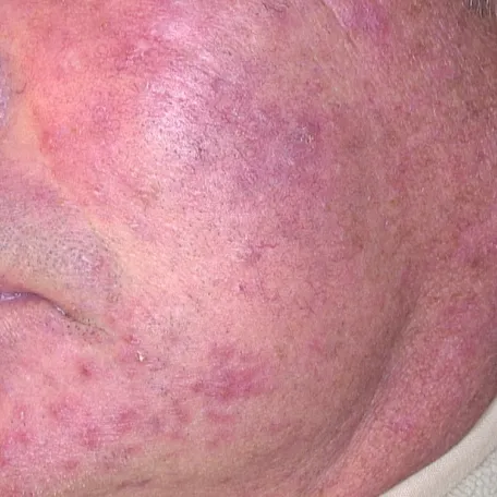 rosacée papulo pustuleuse