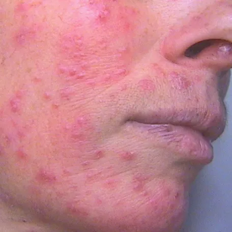 rosacée_papulo-pustuleuse_2